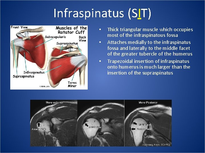 Infraspinatus (SIT) • • • Thick triangular muscle which occupies most of the infraspinatous