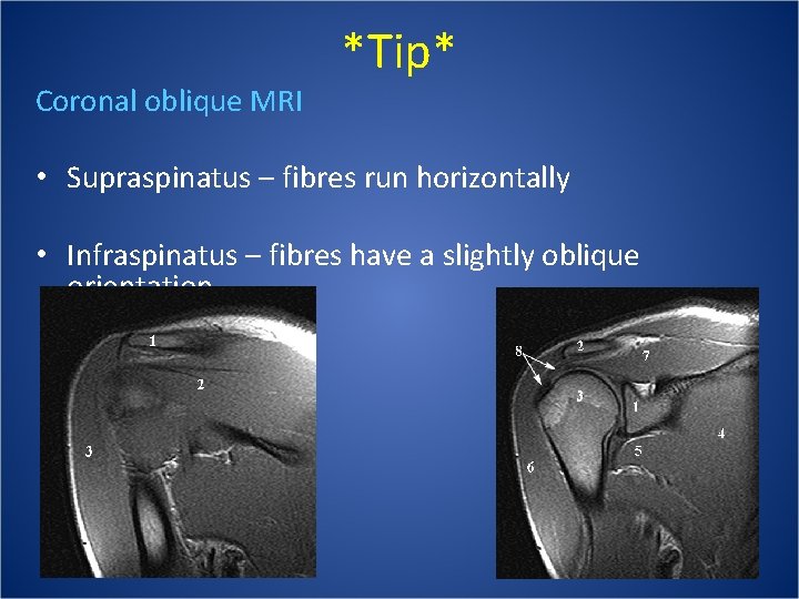 Coronal oblique MRI *Tip* • Supraspinatus – fibres run horizontally • Infraspinatus – fibres