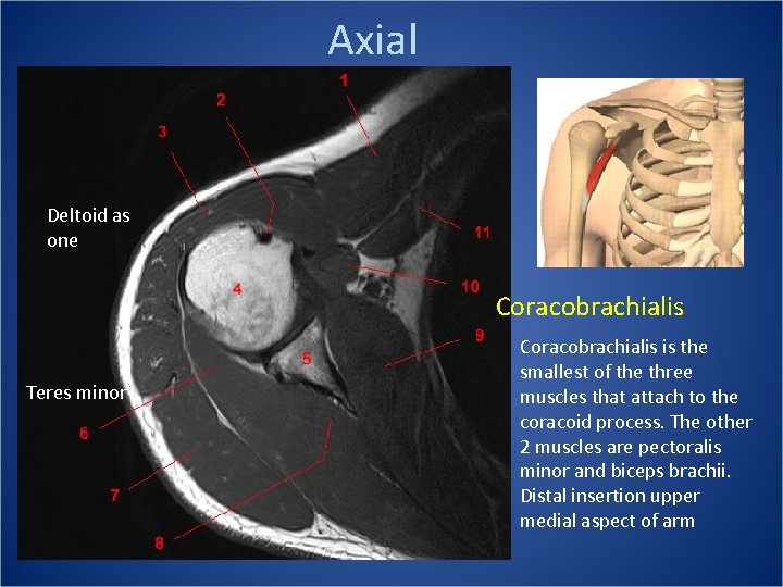 Axial Deltoid as one Coracobrachialis Teres minor Coracobrachialis is the smallest of the three