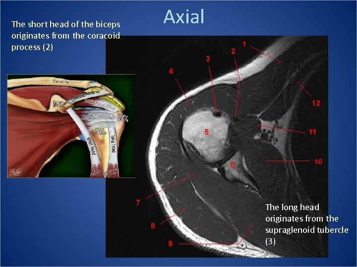 The short head of the biceps originates from the coracoid process (2) Axial The