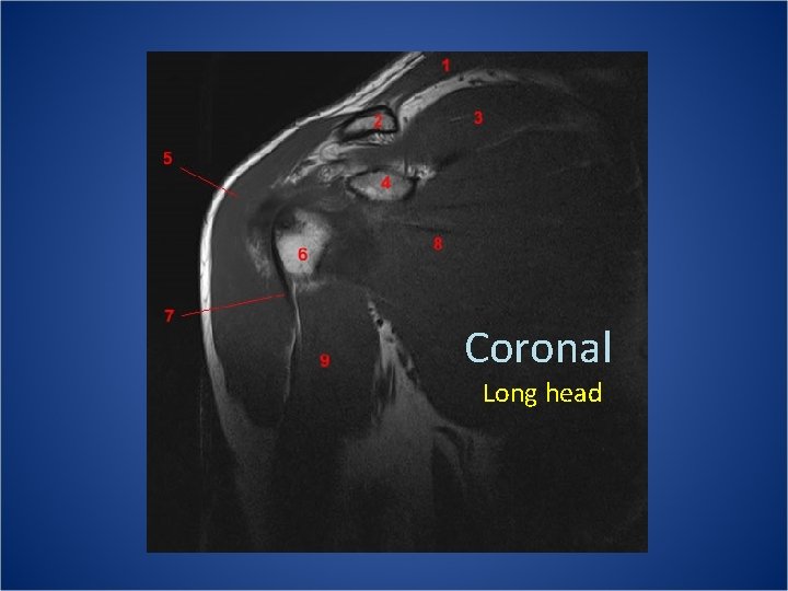 Coronal Long head 