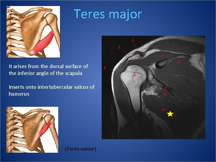 Teres major It arises from the dorsal surface of the inferior angle of the