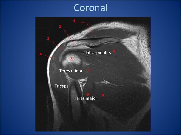 Coronal Infraspinatus Teres minor Triceps Teres major 