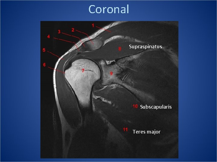 Coronal Supraspinatus Subscapularis Teres major 