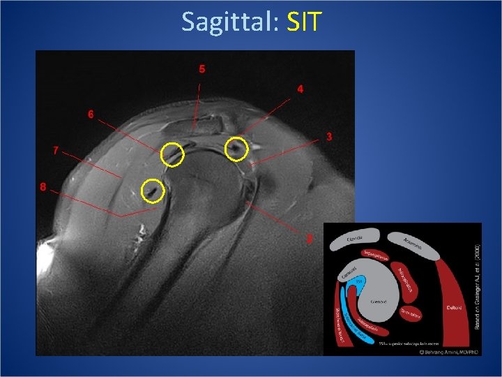 Sagittal: SIT 