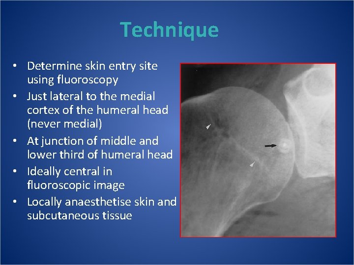 Technique • Determine skin entry site using fluoroscopy • Just lateral to the medial