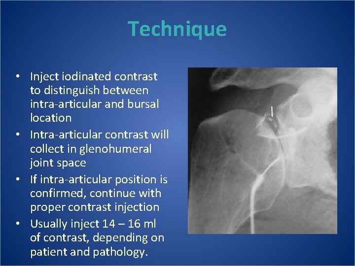 Technique • Inject iodinated contrast to distinguish between intra-articular and bursal location • Intra-articular