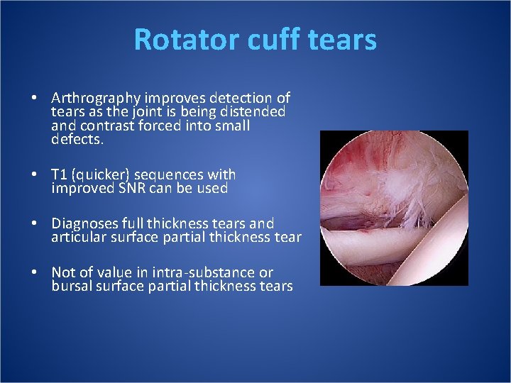 Rotator cuff tears • Arthrography improves detection of tears as the joint is being