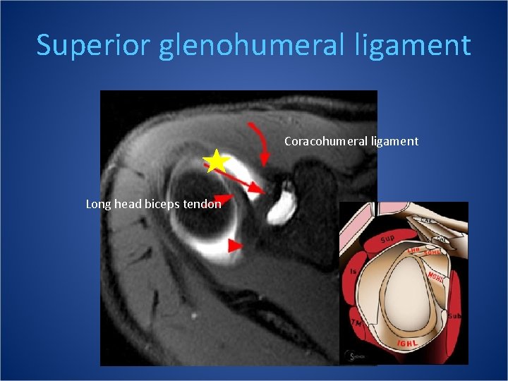 Superior glenohumeral ligament Coracohumeral ligament Long head biceps tendon 