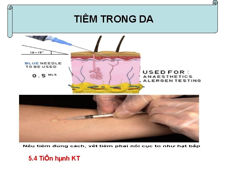 I. tiªm. TRONG trong da TIÊM DA 5. TiÕn hµnh kü thuËt 5. 4