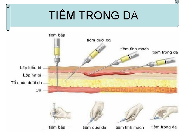 I. Tiªm trong da TIÊM TRONG DA 