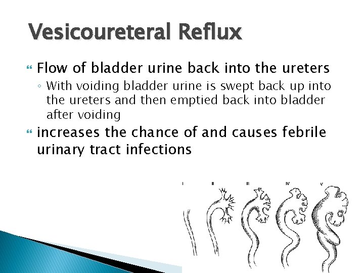 Vesicoureteral Reflux Flow of bladder urine back into the ureters ◦ With voiding bladder Vesicoureteral Reflux Flow of bladder urine back into the ureters ◦ With voiding bladder