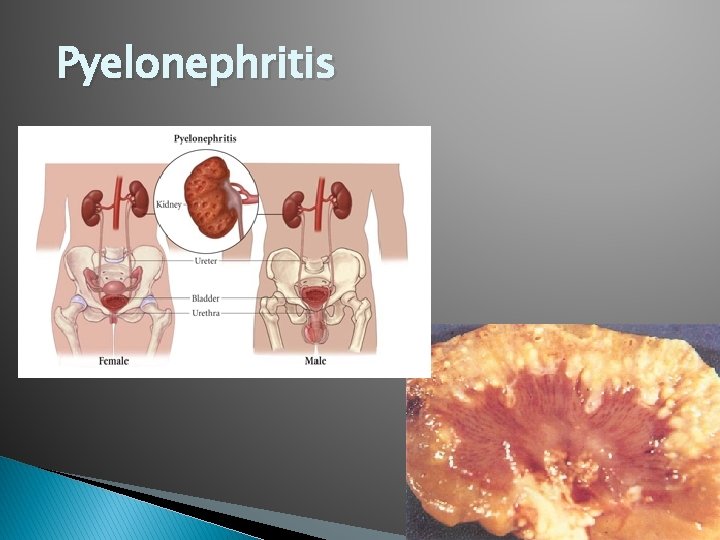 Pyelonephritis 