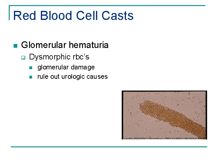 Red Blood Cell Casts n Glomerular hematuria q Dysmorphic rbc’s n n glomerular damage