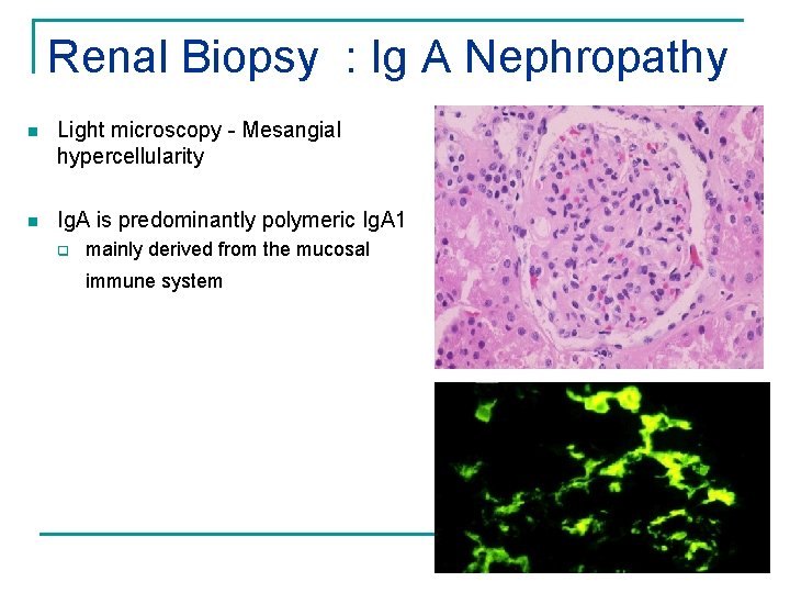 Renal Biopsy : Ig A Nephropathy n Light microscopy - Mesangial hypercellularity n Ig.