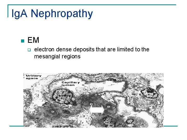 Ig. A Nephropathy n EM q electron dense deposits that are limited to the