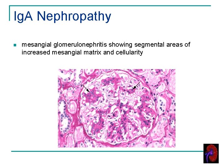 Ig. A Nephropathy n mesangial glomerulonephritis showing segmental areas of increased mesangial matrix and