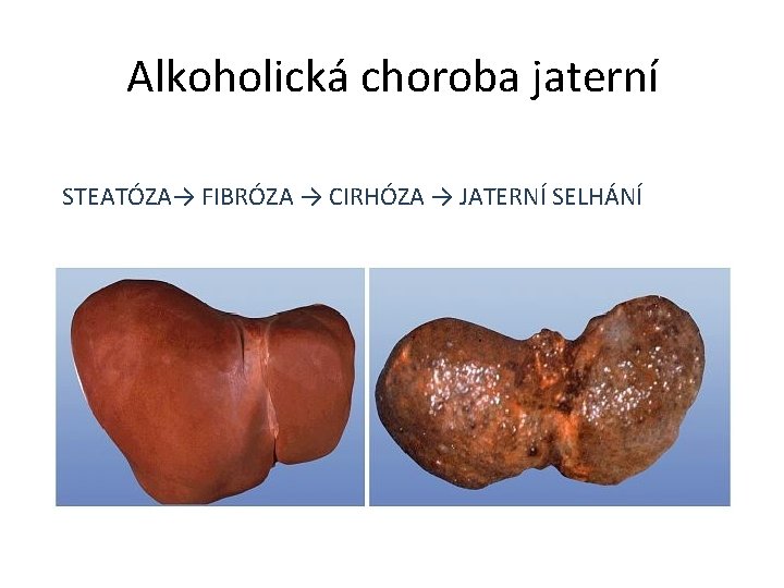 Alkoholická choroba jaterní STEATÓZA→ FIBRÓZA → CIRHÓZA → JATERNÍ SELHÁNÍ 