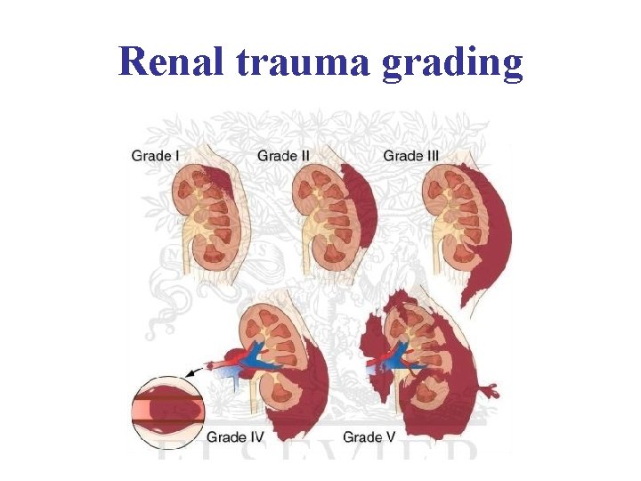 Renal trauma grading 