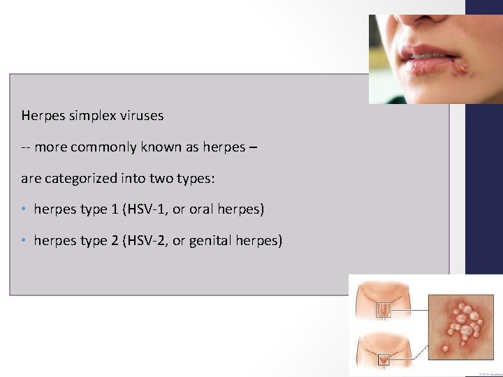 Herpes simplex viruses -- more commonly known as herpes – are categorized into two