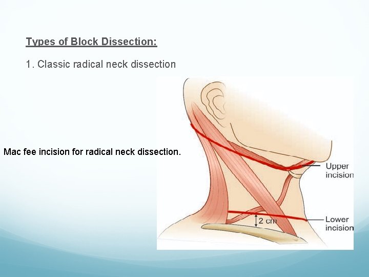 Types of Block Dissection: 1. Classic radical neck dissection Mac fee incision for radical