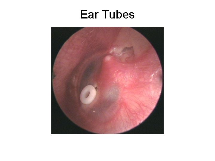 Ear Tubes 