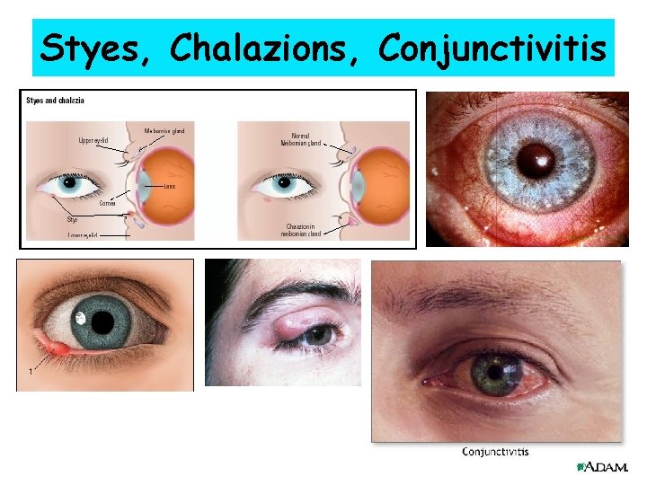 Styes, Chalazions, Conjunctivitis 