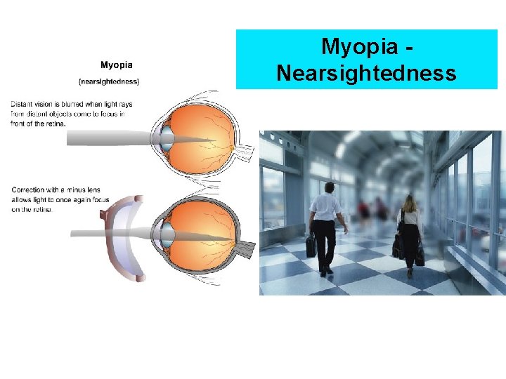 Myopia Nearsightedness 