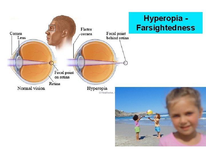 Hyperopia Farsightedness 