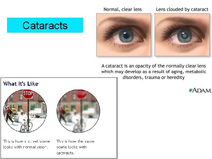 Cataracts 