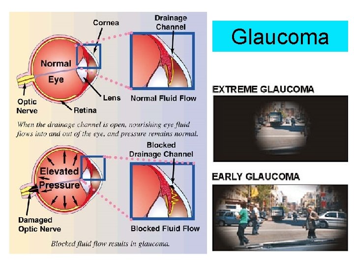 Glaucoma 