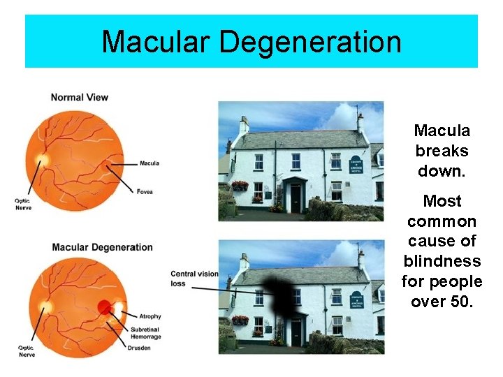 Macular Degeneration Macula breaks down. Most common cause of blindness for people over 50.