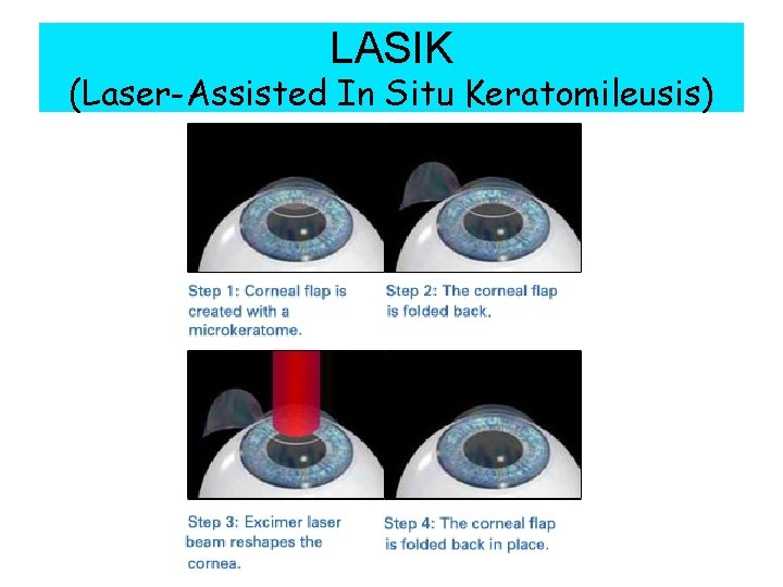 LASIK (Laser-Assisted In Situ Keratomileusis) 