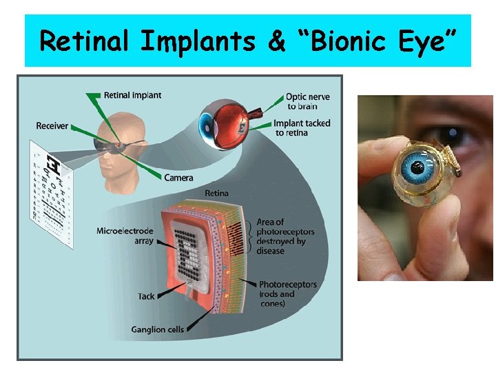 Retinal Implants & “Bionic Eye” 