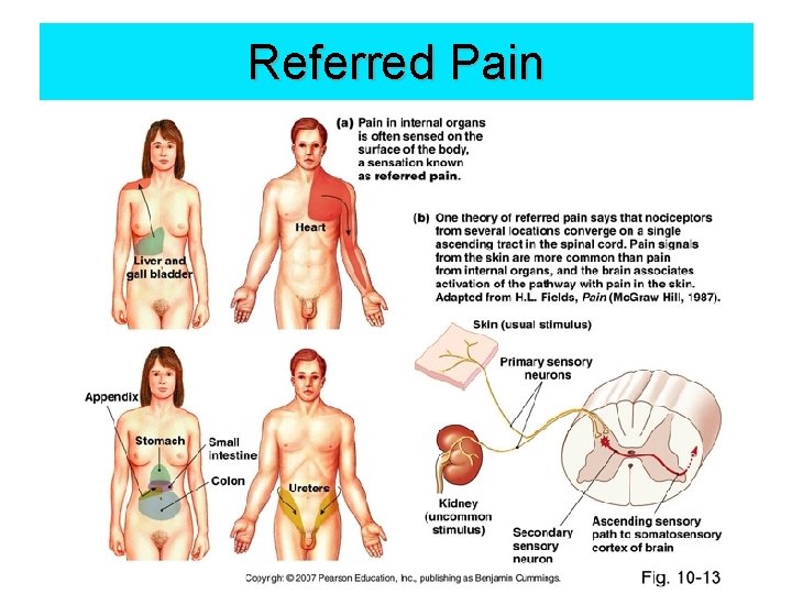 Referred Pain 