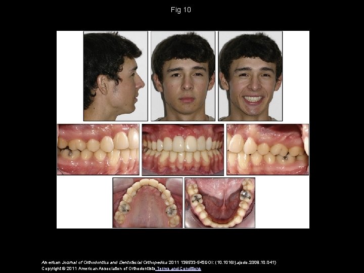 Fig 10 American Journal of Orthodontics and Dentofacial Orthopedics 2011 139533 -543 DOI: (10.