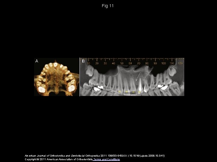 Fig 11 American Journal of Orthodontics and Dentofacial Orthopedics 2011 139533 -543 DOI: (10.