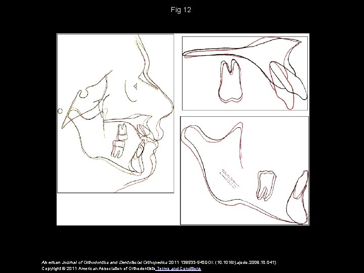 Fig 12 American Journal of Orthodontics and Dentofacial Orthopedics 2011 139533 -543 DOI: (10.