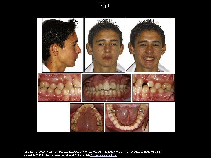 Fig 1 American Journal of Orthodontics and Dentofacial Orthopedics 2011 139533 -543 DOI: (10.