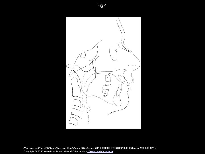 Fig 4 American Journal of Orthodontics and Dentofacial Orthopedics 2011 139533 -543 DOI: (10.