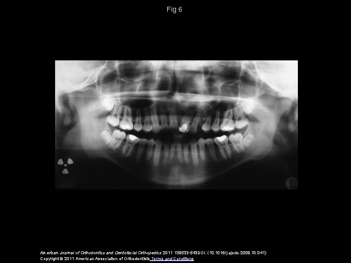 Fig 6 American Journal of Orthodontics and Dentofacial Orthopedics 2011 139533 -543 DOI: (10.