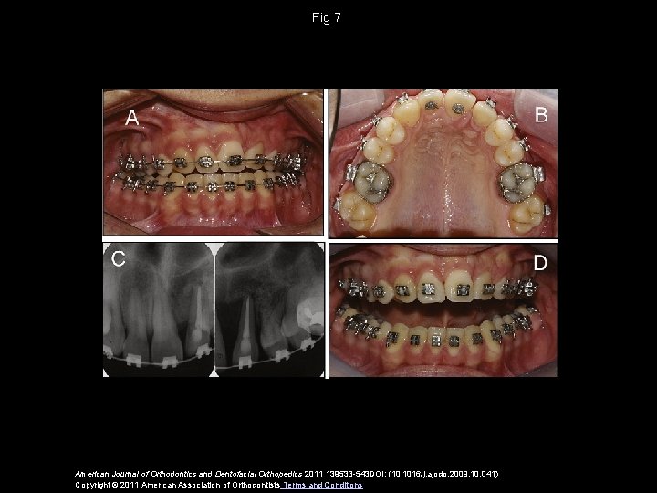 Fig 7 American Journal of Orthodontics and Dentofacial Orthopedics 2011 139533 -543 DOI: (10.