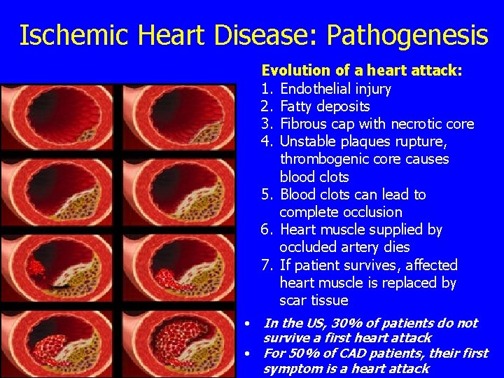 Ischemic Heart Disease: Pathogenesis Evolution of a heart attack: 1. Endothelial injury 2. Fatty
