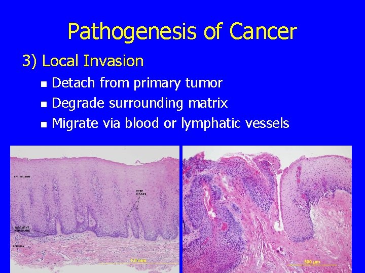 Pathogenesis of Cancer 3) Local Invasion n Detach from primary tumor Degrade surrounding matrix