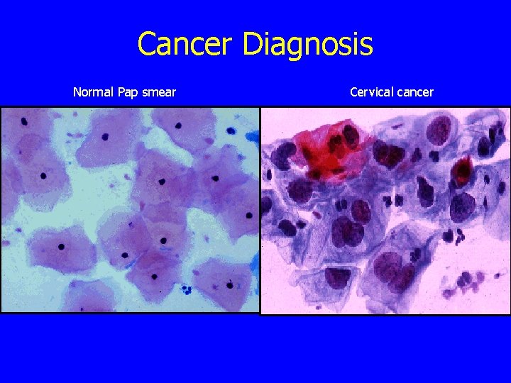 Cancer Diagnosis Normal Pap smear Cervical cancer 