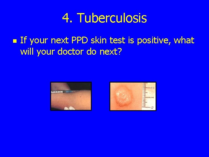 4. Tuberculosis n If your next PPD skin test is positive, what will your