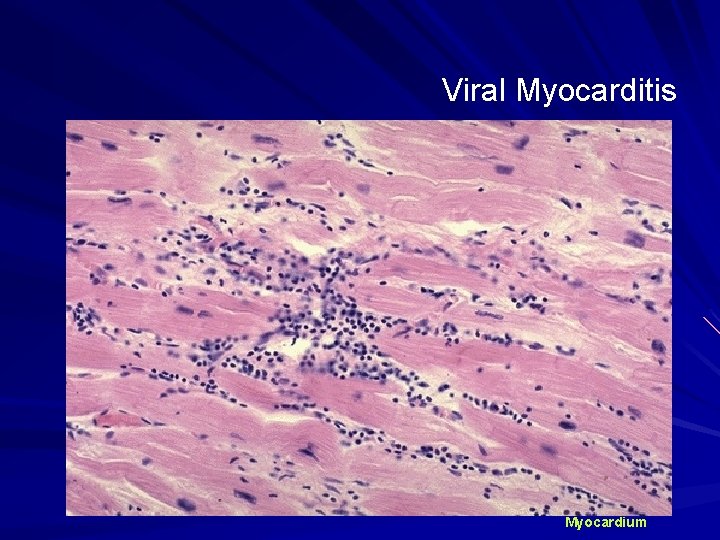 Viral Myocarditis Myocardium 