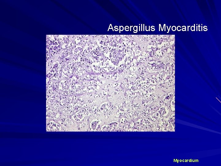 Aspergillus Myocarditis Myocardium 