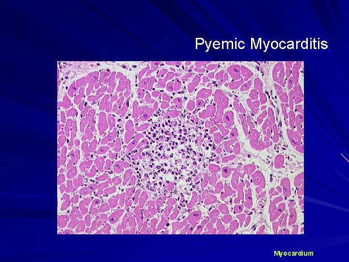 Pyemic Myocarditis Myocardium 