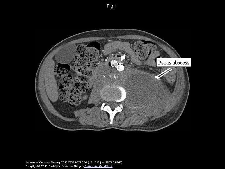 Fig 1 Journal of Vascular Surgery 2013 58371 -379 DOI: (10. 1016/j. jvs. 2013.